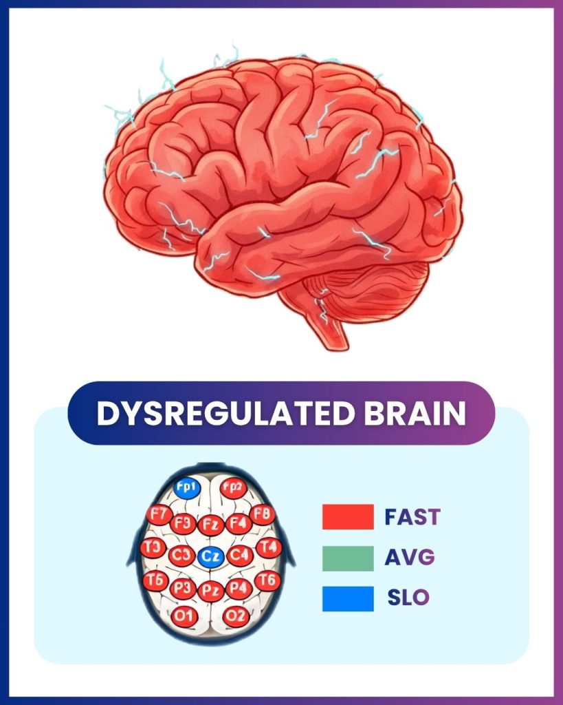 Illustration of a dysregulated brain with color-coded regions showing processing speed