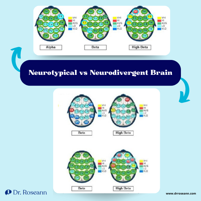 Neurotypical vs Neurodivergent Brain
