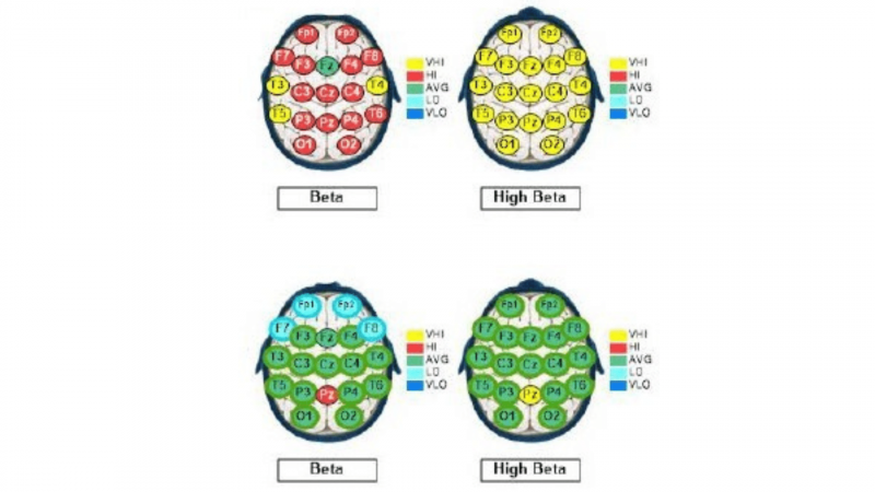 QEEG Brain Map Comparison from QEEG #1 to #3 after 50 sessions of Neurofeedback, 5 sessions of PEMFBRT and individual and family therapy in our BrainBehaviorReset™ Program. (1)